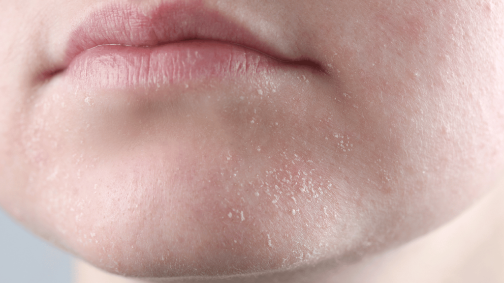 dry skin