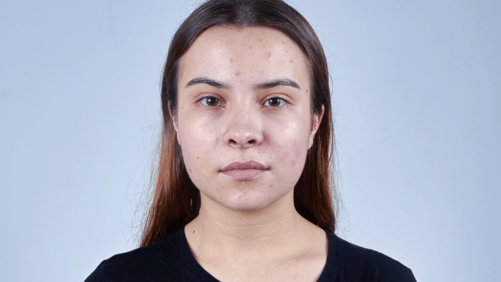 combination skin